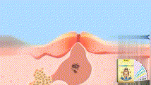 Acne Patch | Portable Cartoon Acne Treatment