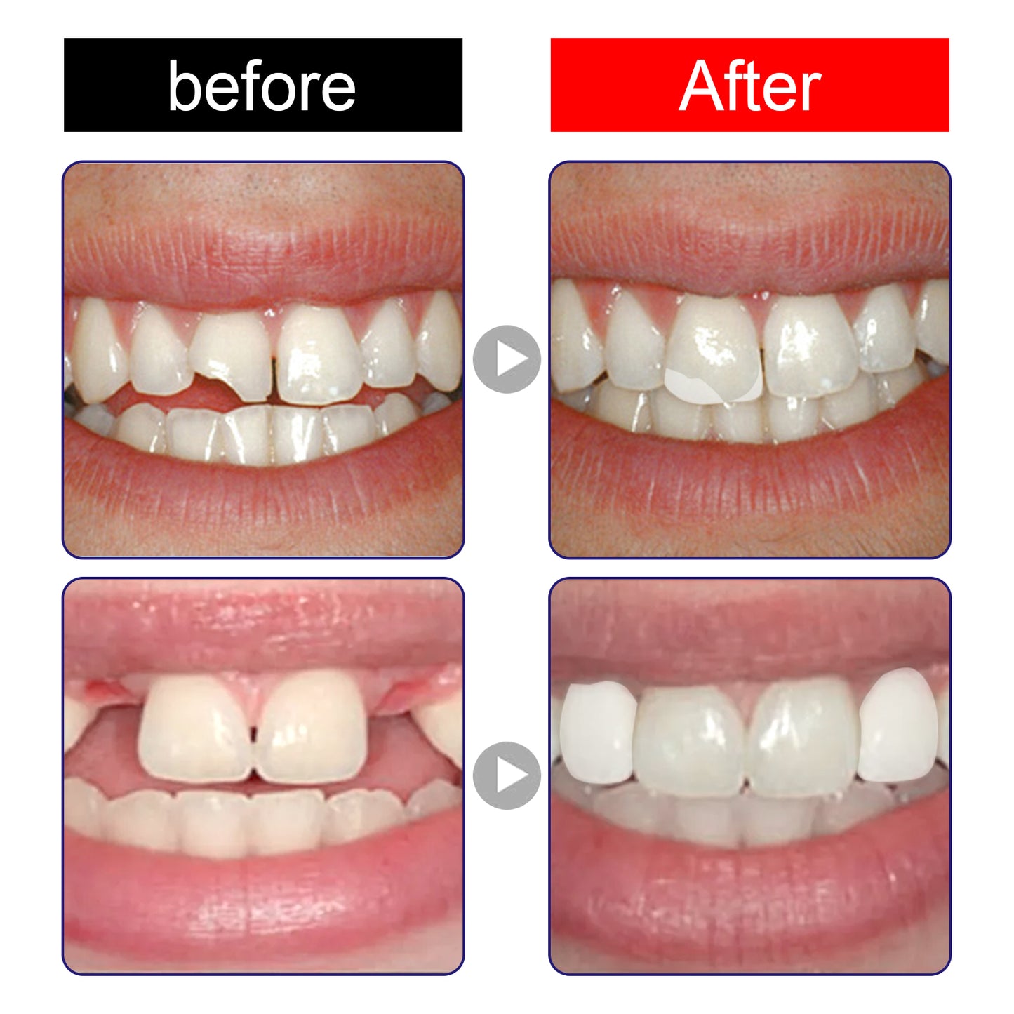 Moldable Dental Filling Adhesive | 30ml Box