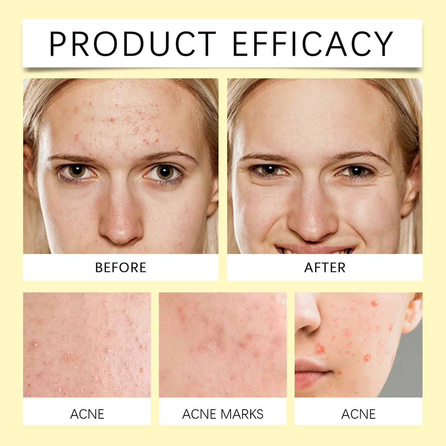Acne Patch | Portable Cartoon Acne Treatment